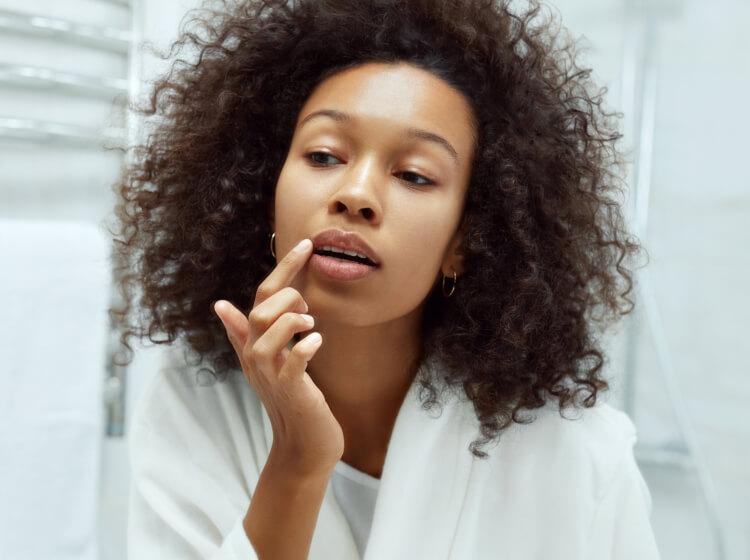 Woman with treated cold sores